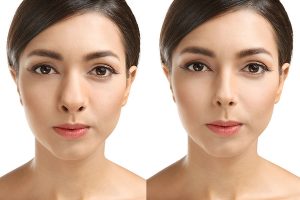 Reasons Why People Have Rhinoplasty Done