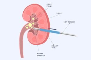 Choosing the Right Path: Understanding the Differences between PCNL and Other Kidney Stone Removal Techniques