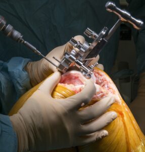 Maximizing Recovery and Mobility After Knee Replacement Surgery