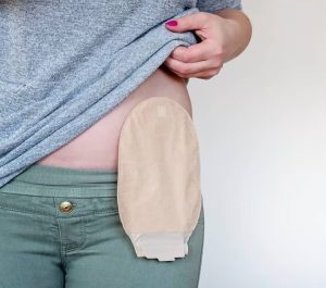 Understanding Urinary Diversion: Types- Benefits and Lifestyle Adjustments