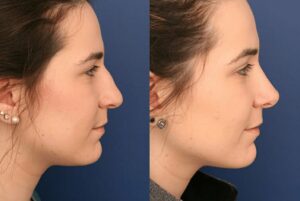 What to Know About Rhinoplasty Costs and Benefits
