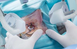 What Happens During a Laser Eye Surgery Consultation?